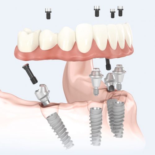 All-on-4 mit Schrauben