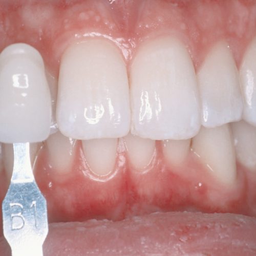 Bleaching-Zaehne-bleichen-nachher