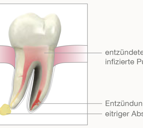 csm_Endodontische-Behandlung-02_8059956826