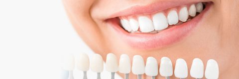 csm_veneers_2788e3abac