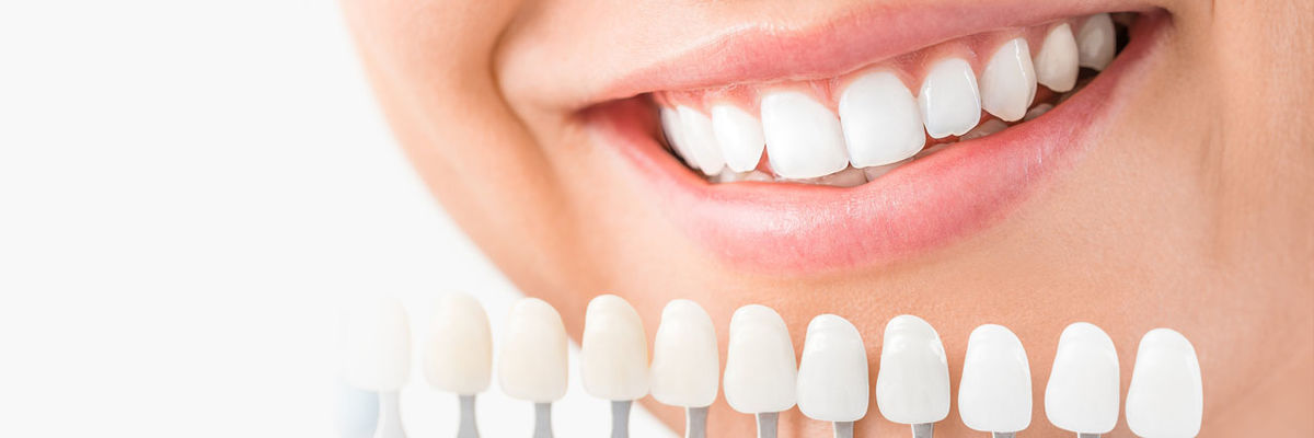 csm_veneers_2788e3abac