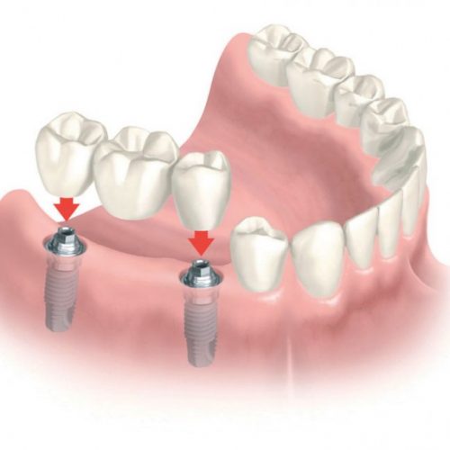 festsitzender-zahnersatz-806x570