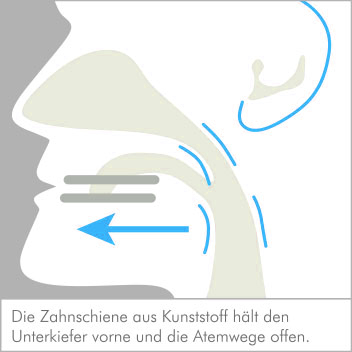 schnarcherschiene
